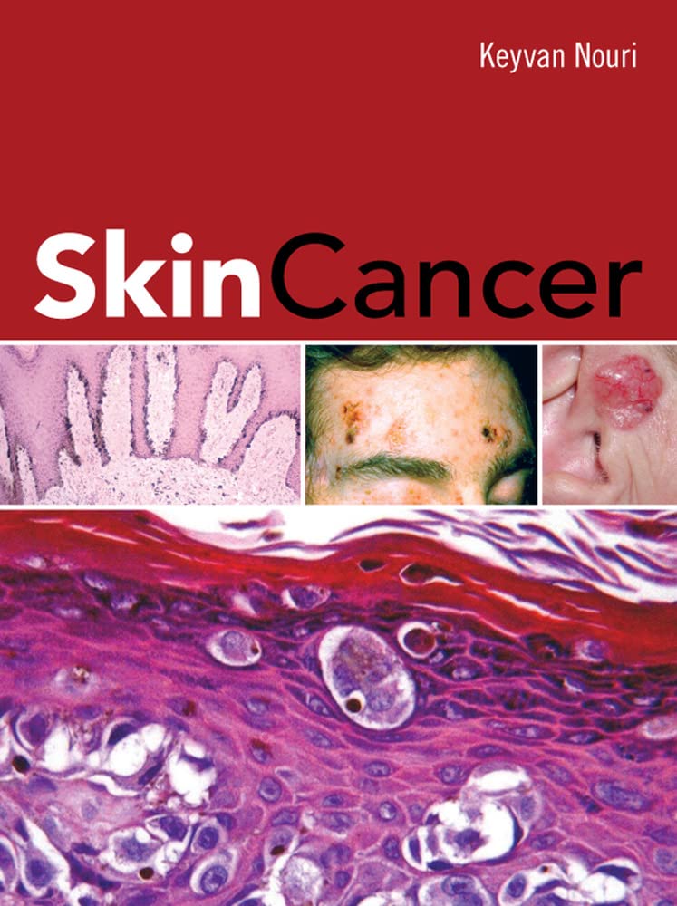 Skin Cancer