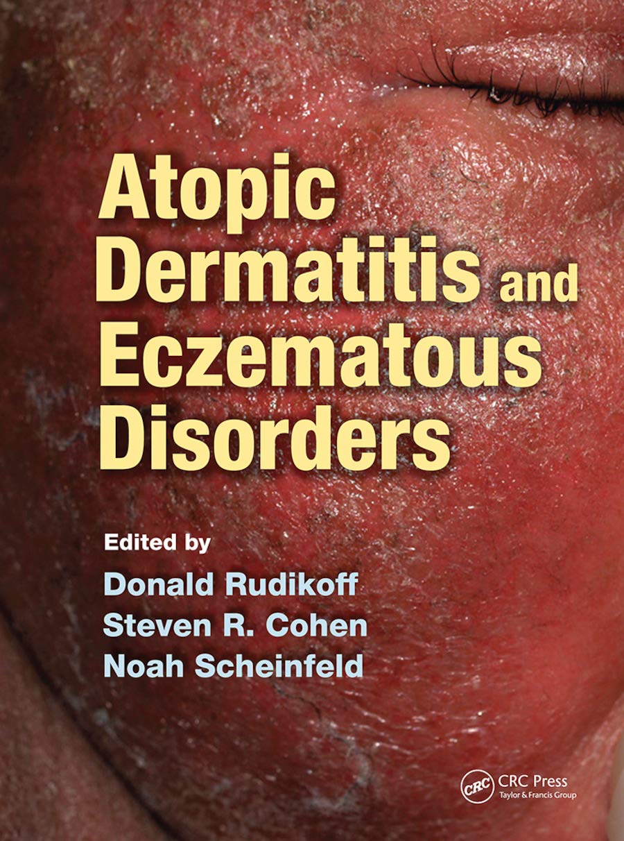 Atopic Dermatitis and Eczematous Disorders